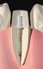 Picture of Flexi-Flange - Essential Dental Systems