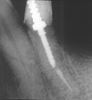 Picture of Flexi-Flange Titanium- Essential Dental Systems